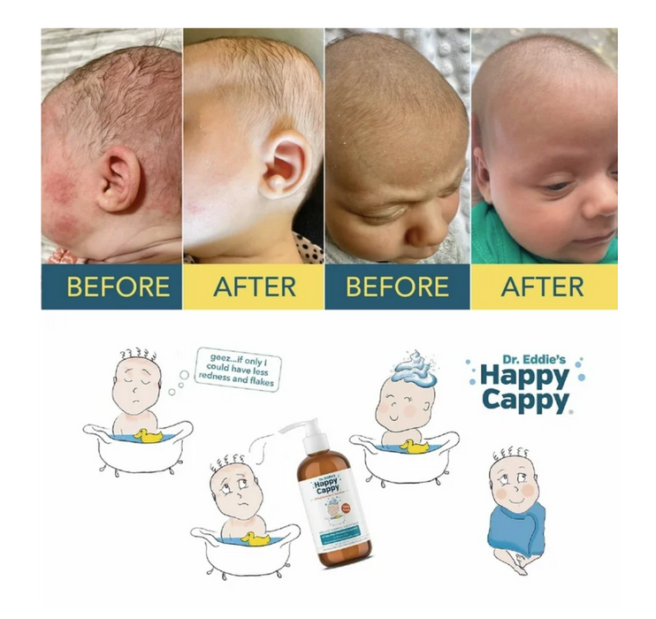 Dr. Eddie's Happy Cappy, Medicated Shampoo & Body Wash for Seborrheic Dermatitis & Dandruff -8oz